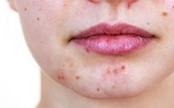 Cách trị mụn nội tiết