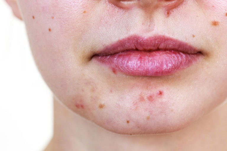Cách trị mụn nội tiết