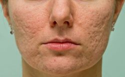 Cách trị sẹo rỗ hiệu quả