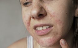 Dị ứng càng nặng sẽ khiến làn da chịu tổn thương càng lớn