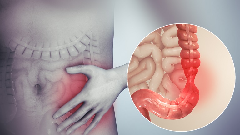 Hội chứng ruột kích thích là gì? Nguyên nhân, triệu chứng và phương pháp điều trị AN TOÀN