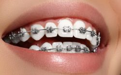 Niềng răng mắc cài kim loại là một trong những phương pháp phổ biến nhất hiện nay