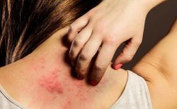Bệnh nổi mề đay mẩn ngứa xảy ra ở phụ nữ phổ biến hơn so với nam giới