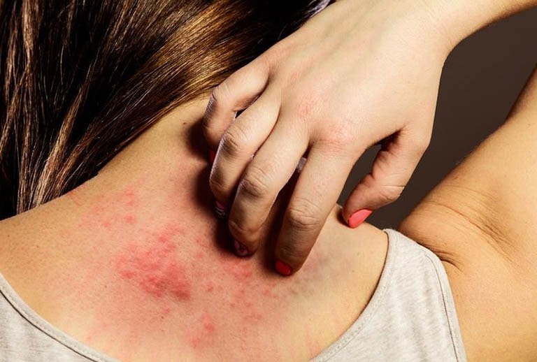 Bệnh nổi mề đay mẩn ngứa xảy ra ở phụ nữ phổ biến hơn so với nam giới