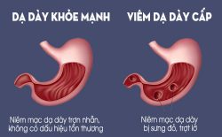 Viêm dạ dày là một dạng tổn thương ống tiêu hóa thường gặp