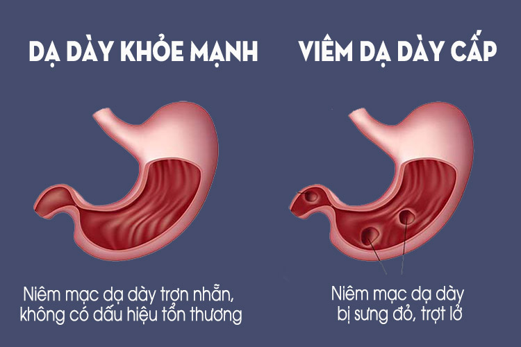 Viêm dạ dày là một dạng tổn thương ống tiêu hóa thường gặp