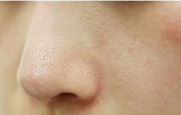 Cách trị mụn ẩn hiệu quả