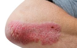 [Chuyên Gia Giải Đáp] Vảy Nến Là Bệnh Gì, Triệu Chứng, Nguyên Nhân Và Các Cách Điều Trị Hiệu Quả Nhất 