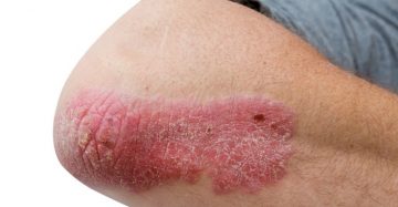[Chuyên Gia Giải Đáp] Vảy Nến Là Bệnh Gì, Triệu Chứng, Nguyên Nhân Và Các Cách Điều Trị Hiệu Quả Nhất 