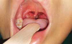 Amidan mặc dù có chức năng miễn dịch nhưng rất dễ bị viêm nhiễm