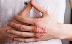 Bệnh Viêm Da Cơ Địa: Nguyên Nhân, Triệu Chứng, Cách Điều Trị Và Lưu Ý Cần Nhớ
