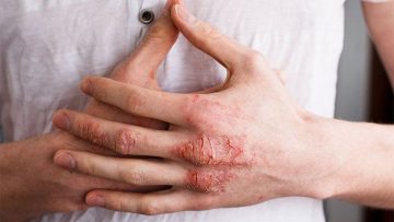 Bệnh Viêm Da Cơ Địa: Nguyên Nhân, Triệu Chứng, Cách Điều Trị Và Lưu Ý Cần Nhớ