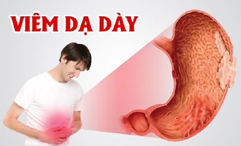 Viêm dạ dày tá tràng là bệnh lý phổ biến ở đường tiêu hóa