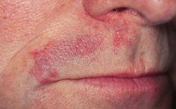 Viêm da tiết bã là bệnh gì?