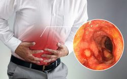 Viêm Đại Tràng Mãn Tính: Nguyên Nhân Và Cách Điều Trị [MỚI NHẤT] 