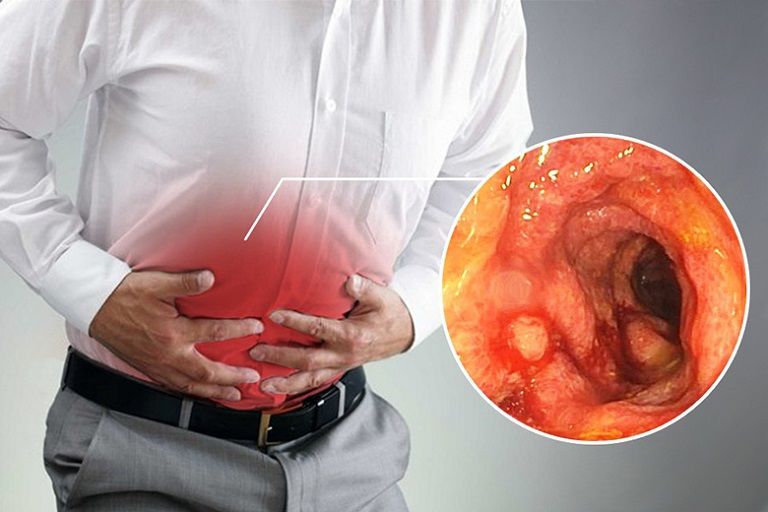 Viêm Đại Tràng Mãn Tính: Nguyên Nhân Và Cách Điều Trị [MỚI NHẤT] 
