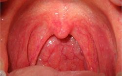Viêm họng chủ yếu do virus gây ra, chỉ có số ít trường hợp do vi khuẩn