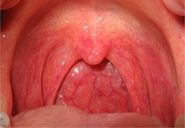 Viêm họng chủ yếu do virus gây ra, chỉ có số ít trường hợp do vi khuẩn