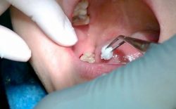 Răng khôn là gì? Biến chứng thường gặp khi mọc răng khôn?